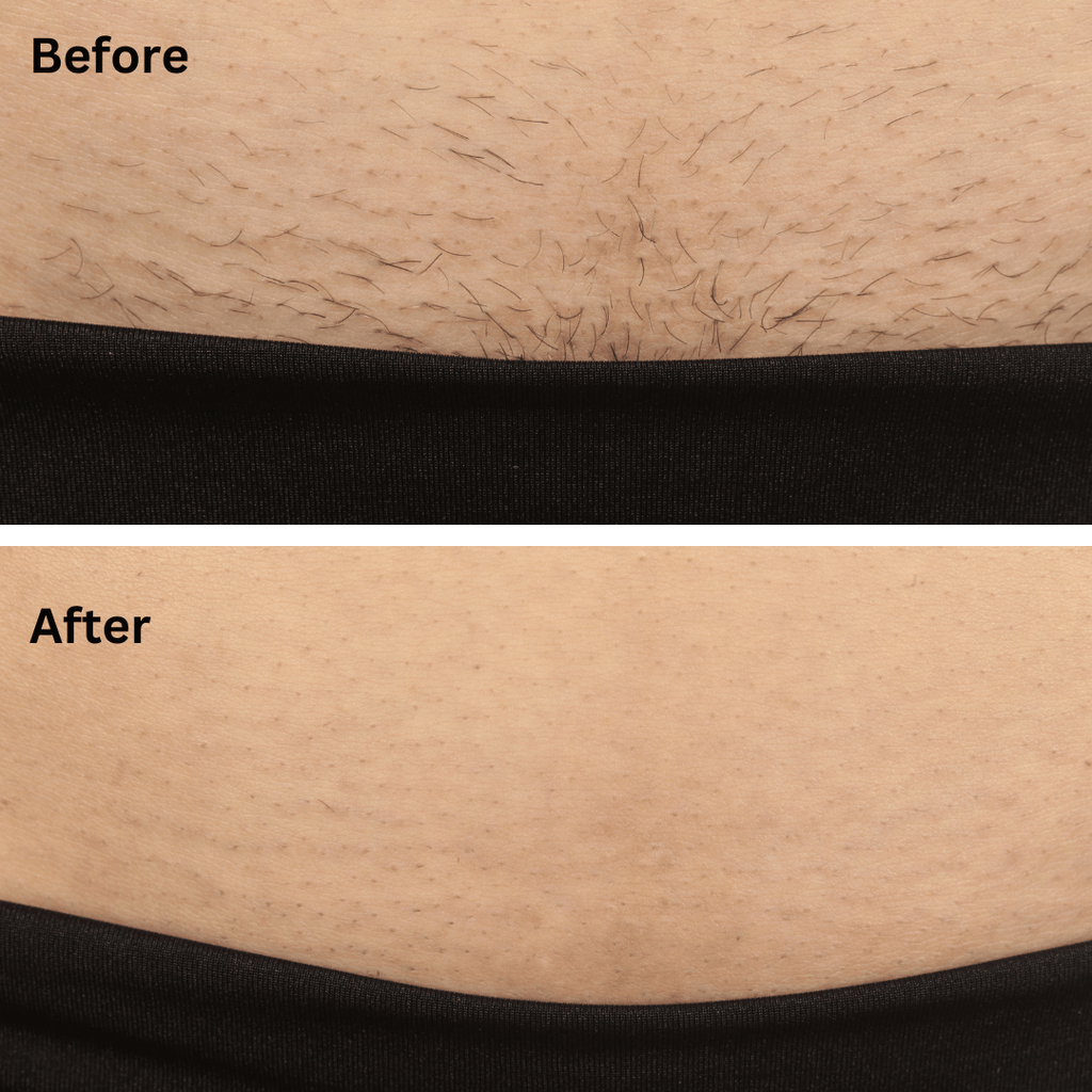 Sensilight™ Pro At-Home IPL Hair Removal
