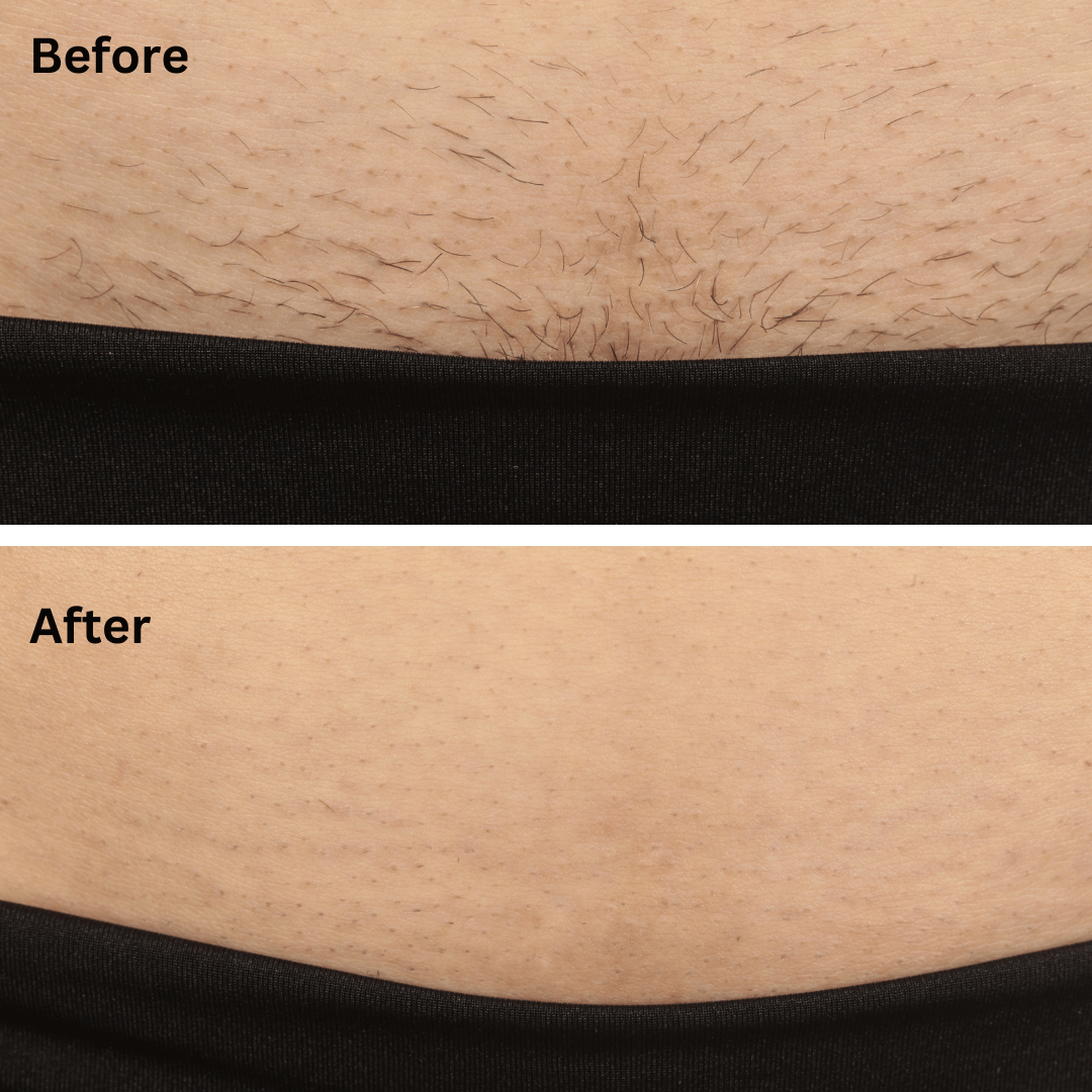Sensilight™ Pro At-Home IPL Hair Removal
