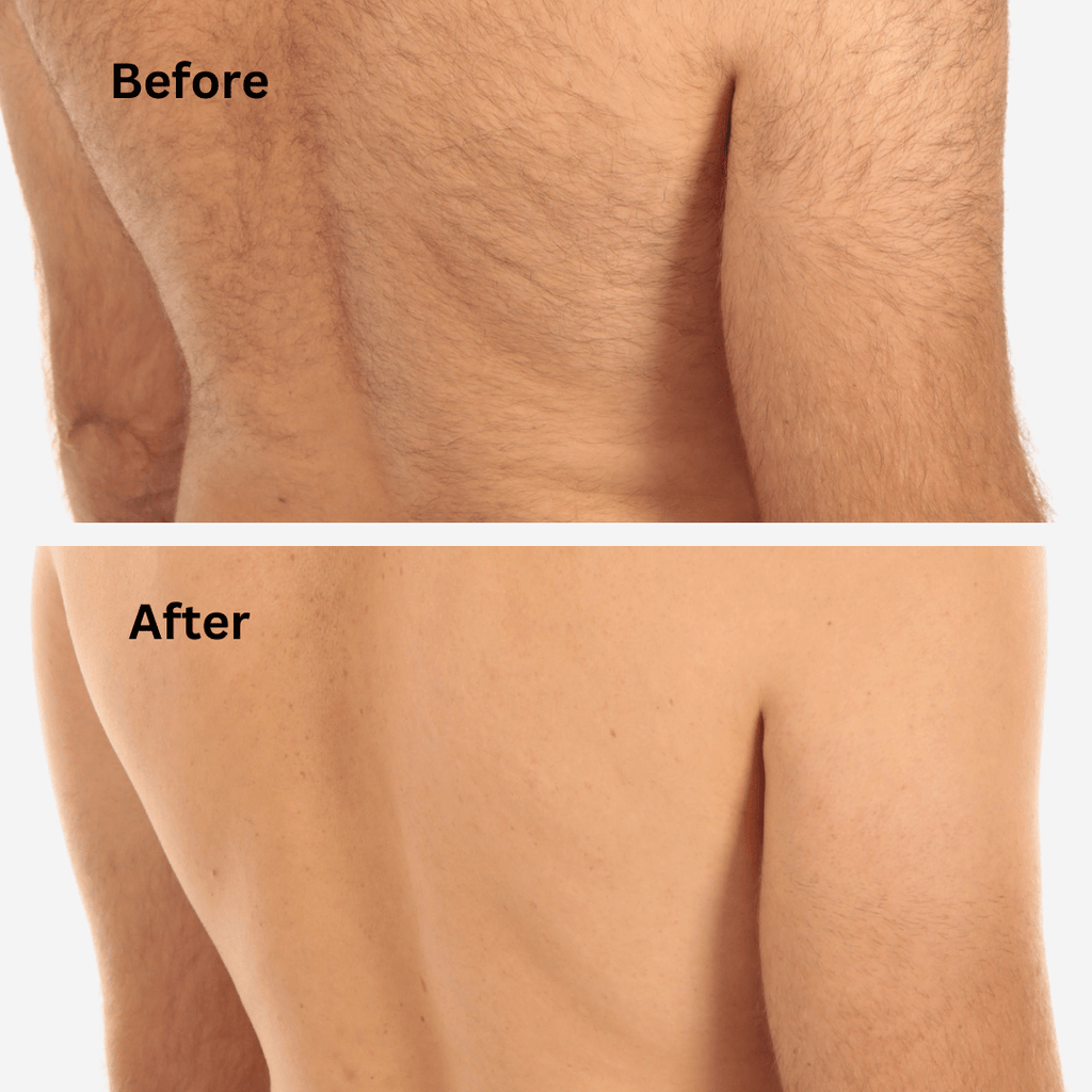 Sensilight™ Pro At-Home IPL Hair Removal